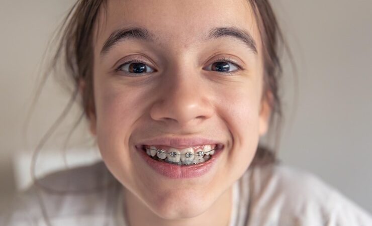 Aparaty samoligaturujące: Nowoczesne rozwiązania w ortodoncji